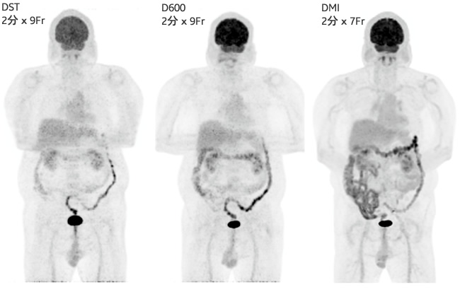 DST、D600、DMIの比較　MIP像 BMIの大きな正常例