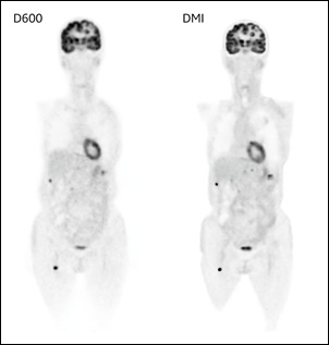 D600とDMIの比較、コロナル像（脳転移・腹膜播種・大腿軟部組織転移レベル）