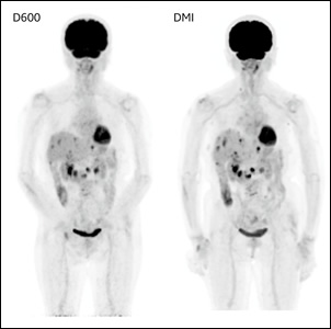 D600とDMIの比較、同一日に撮像（多発肝転移の呼吸性移動が分かる例）