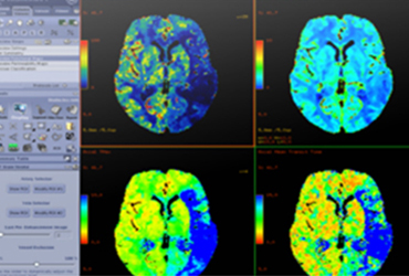CT Perfusion 4D