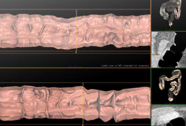 Virtual Colonoscopy