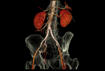 Virtual Colonoscopy