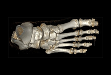 CT Perfusion 4D