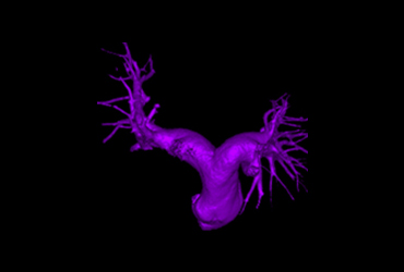 Virtual Colonoscopy