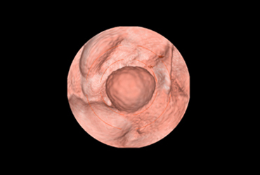 Virtual Colonoscopy