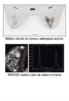 Múltiplo câncer de mama e adenopatia auxiliar. BREASE mostra o pico de colina na mama.