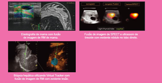 Elastografia de mama com fusão de imagem de RM de mama. Fusão de imagem de SPECT e ultrassom de tireoide com evidente nódulo no lobo direito. Biópsia hepática utilizando Virtual Tracker com fusão de imagem de RM com evidente lesão.