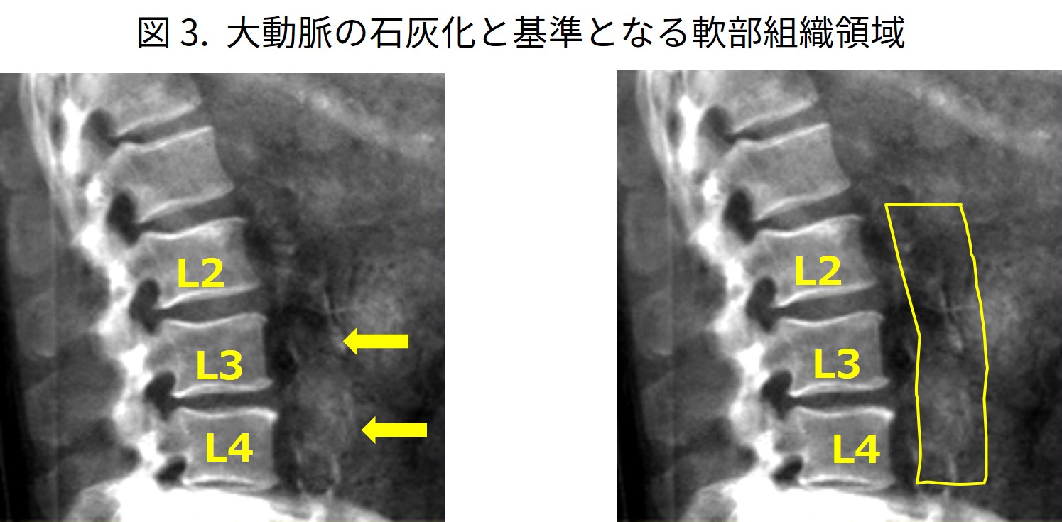DXA法における腰椎側面骨密度に関して ‐ 装置メーカーとしての知見も含め ‐ 今回はDXA法における腰椎側面の骨密度計測に関して、装置 ...