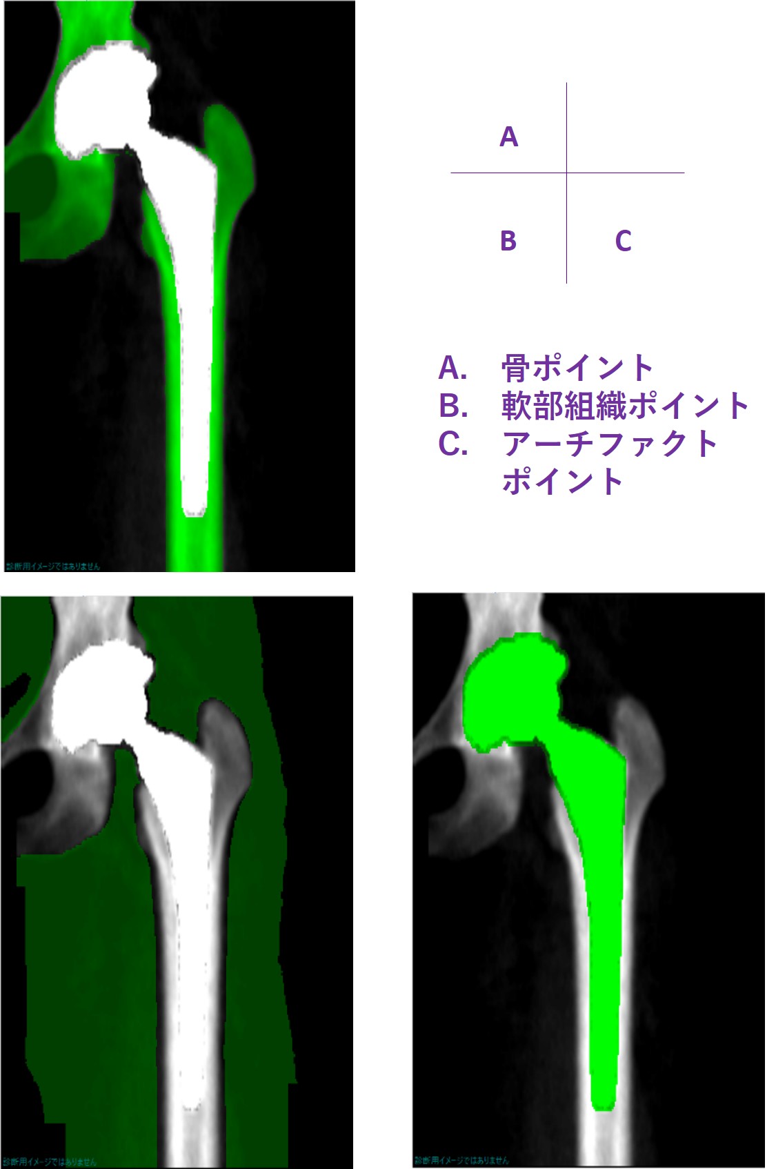 DXA法における人工股関節ソフトウェアについて DXA装置においては、腰椎や大腿骨の骨密度を計測する機能に加え様々な用途に即したソフトウェアが ...