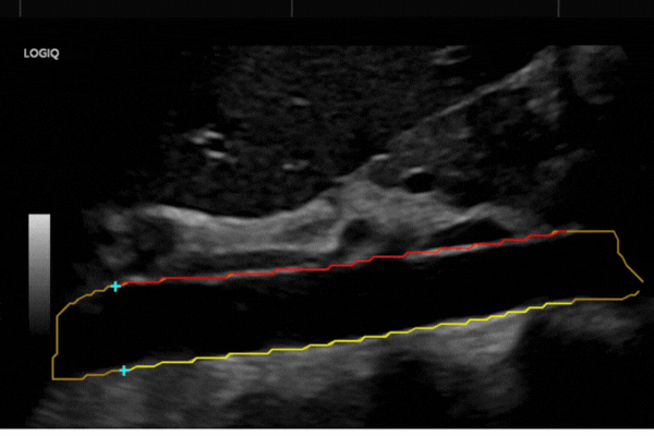 Aorta Proximal Long Segmentation_C1-6
