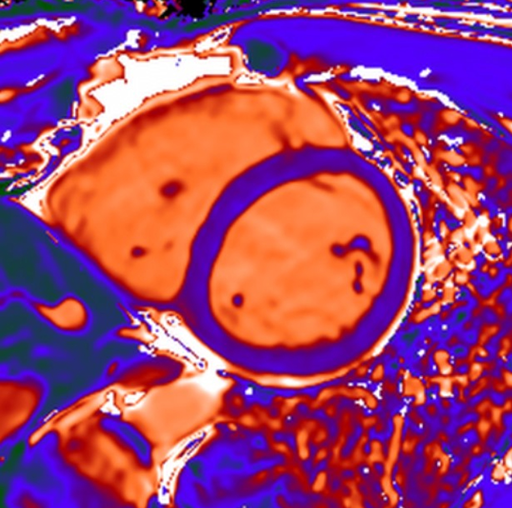 AI e imaging avanzato: due alleati sempre più preziosi nella valutazione cardiologica degli atleti 