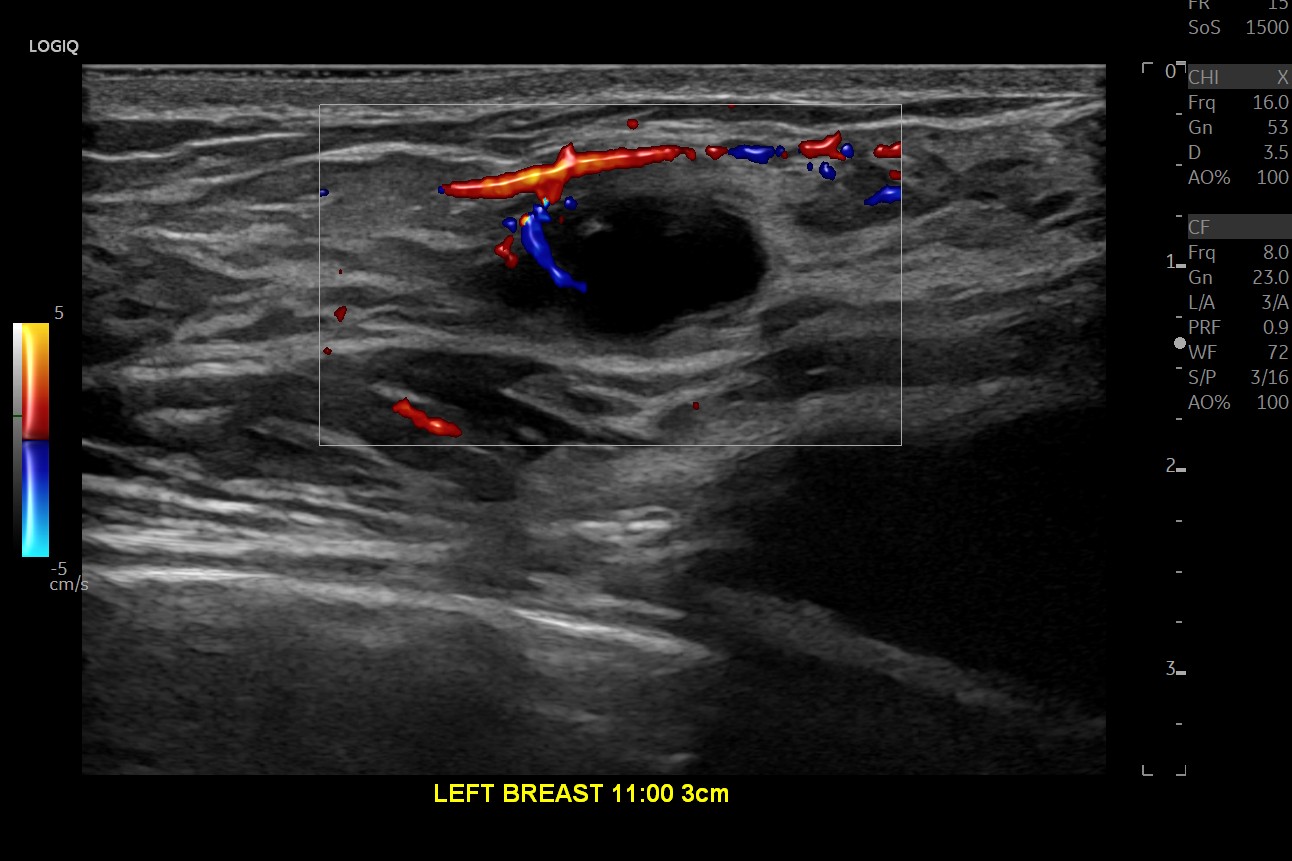 High frequency breast Ultrasound with Color Doppler, ML4-20