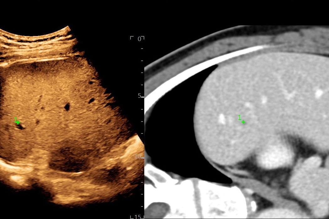 Volume Navigation Contrast Liver Mass with GPS Marker, C1-6-D