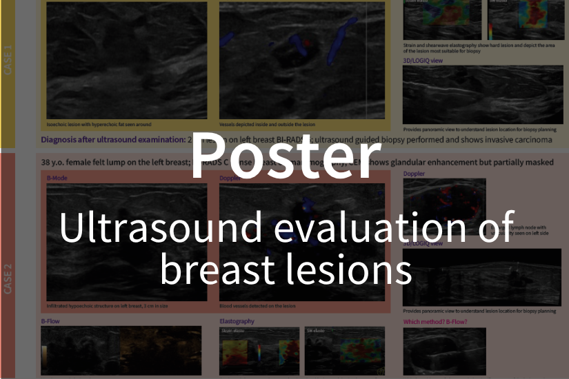 Poster / Ultrasound evaluation of breast lesions