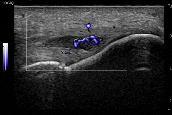 MVI supports detailed vascular imaging, with the addition of Radiantflow, L6-24-D