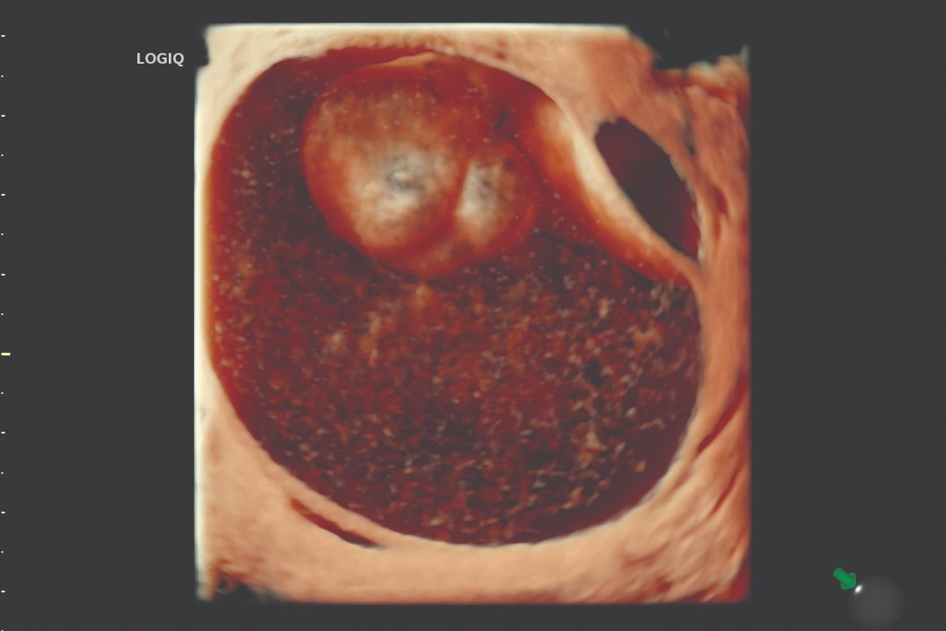 Ovarian mass 3D render with HDlive™, RIC5-9-D