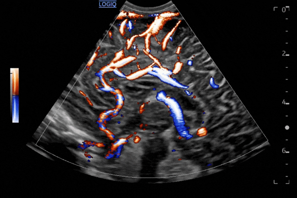 PDI combined with Radiantflow supports detailed vascular imaging using the C3-10-D probe