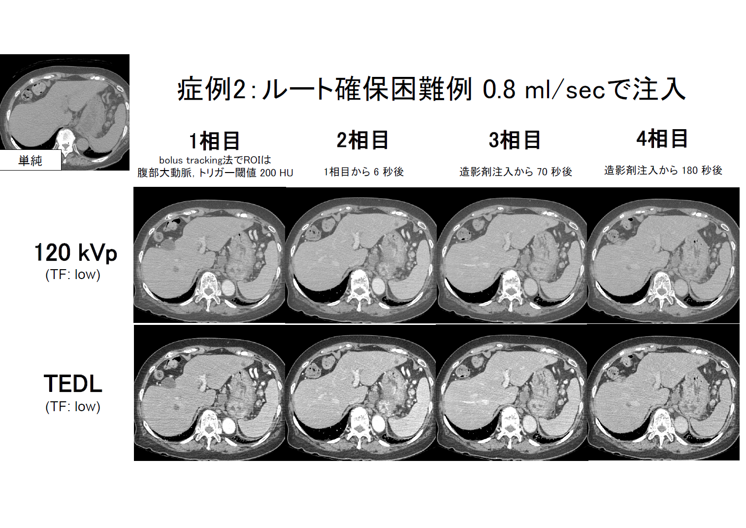 低速注入症例 120kVp と TEDL の比較