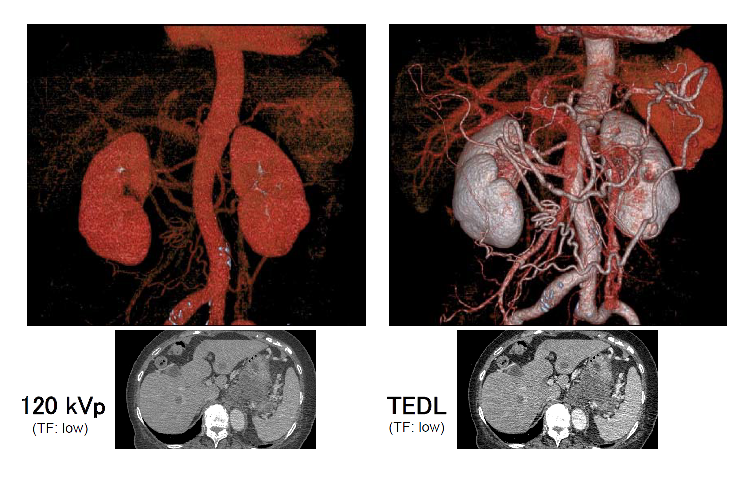造影不良症例の3D画像 120kVp と TEDL の比較