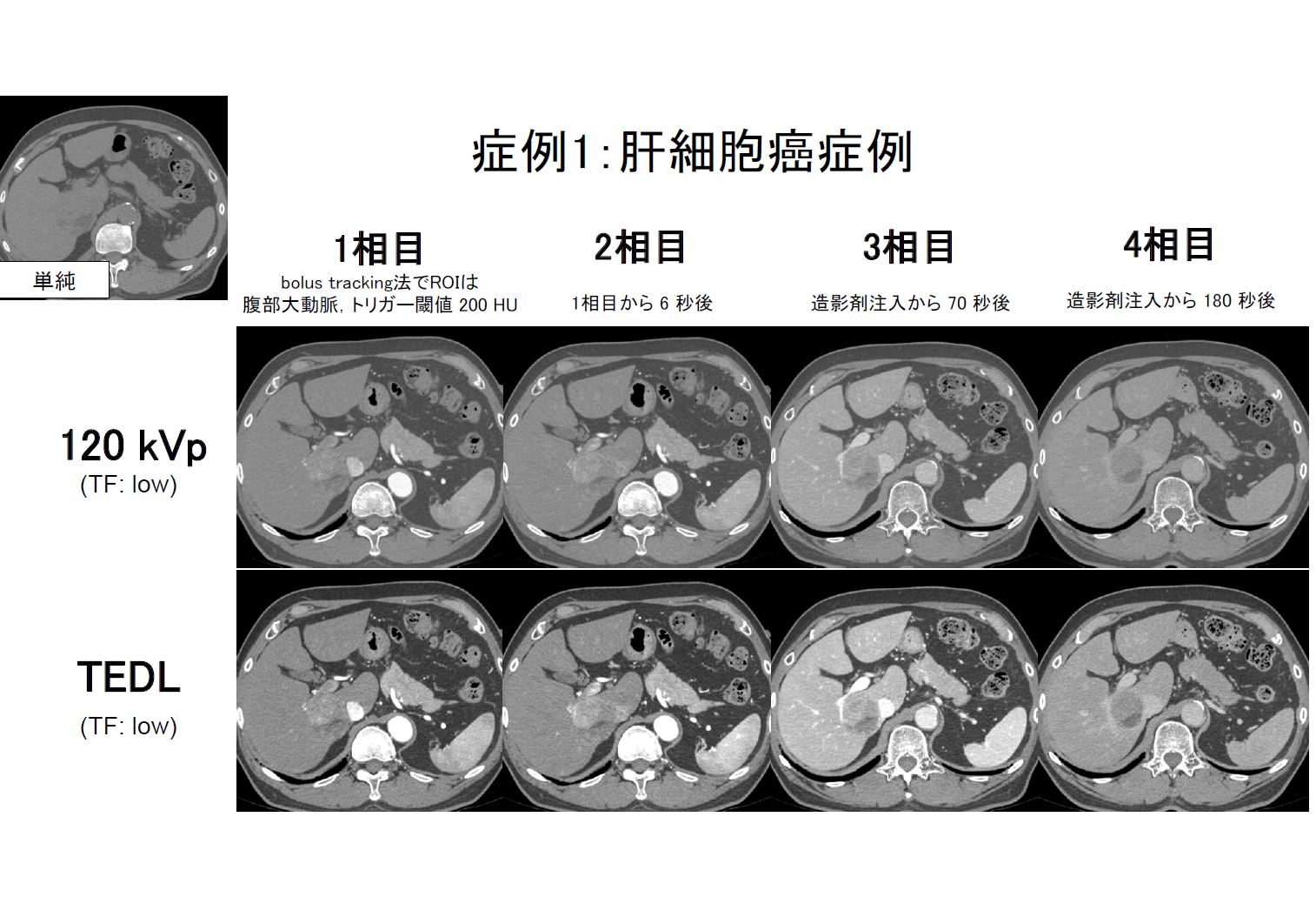 肝細胞癌症例 120kVp と TEDL の比較