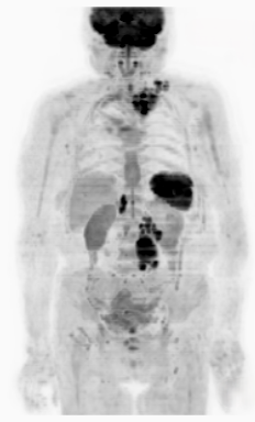 MIP (Invert)