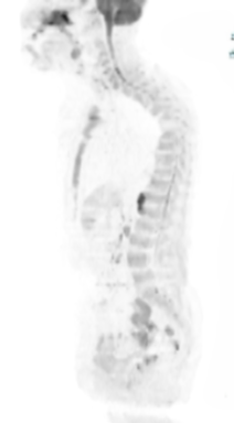 MIP Sag (Invert)