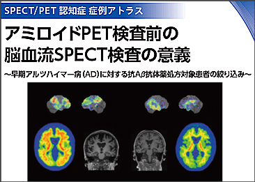 atlas_amyloid - 3.png