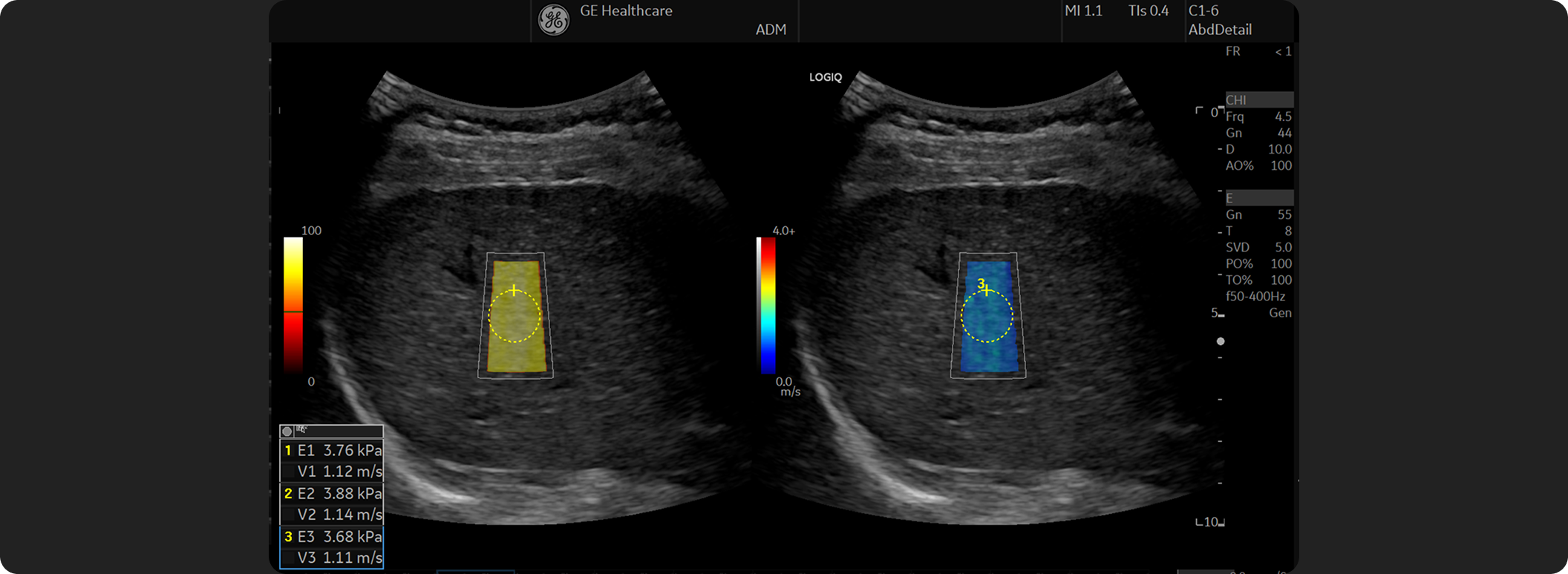 2D Shear Wave Elastography